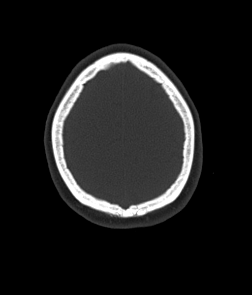 Cerebellar metastases - colorectal adenocarcinoma (Radiopaedia 40947-43652 AX Bone C- 2.0 MPR 55).png