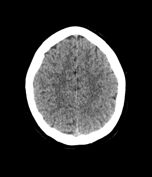 Cerebellar metastases - colorectal adenocarcinoma (Radiopaedia 40947-43652 Axial non-contrast 52).png