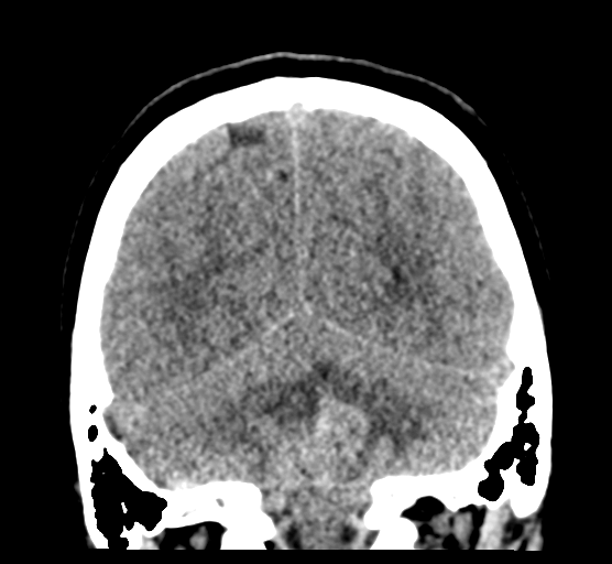 Cerebellar metastases - colorectal adenocarcinoma (Radiopaedia 40947-43652 Coronal non-contrast 72).png