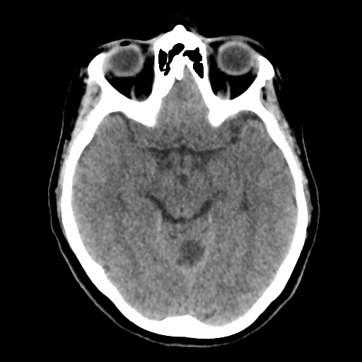 File:Cerebellar metastasis (cystic appearance) (Radiopaedia 41395-44258 Axial non-contrast 23).png