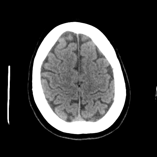 Cerebellar metastasis (cystic appearance) (Radiopaedia 41395-44258 Axial non-contrast 43).png