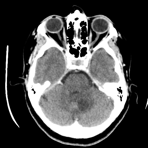 Cerebellar metastasis (cystic appearance) (Radiopaedia 41395-44258 B 16).png