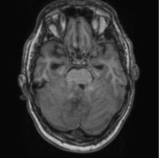 Cerebellar metastasis from lung adenocarcinoma (Radiopaedia 86690-102829 Axial T1 28).png