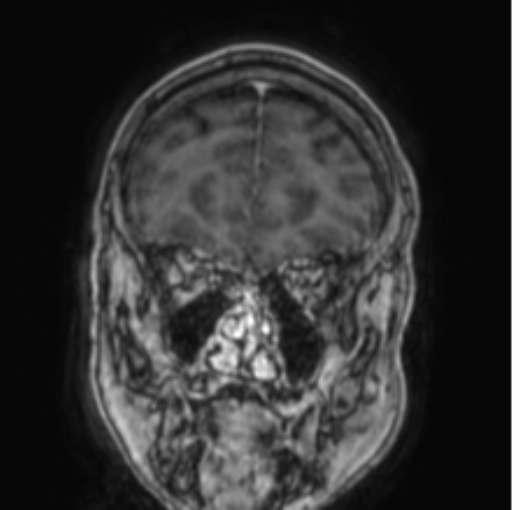 File:Cerebellar metastasis from lung adenocarcinoma (Radiopaedia 86690-102829 Coronal T1 C+ 77).png