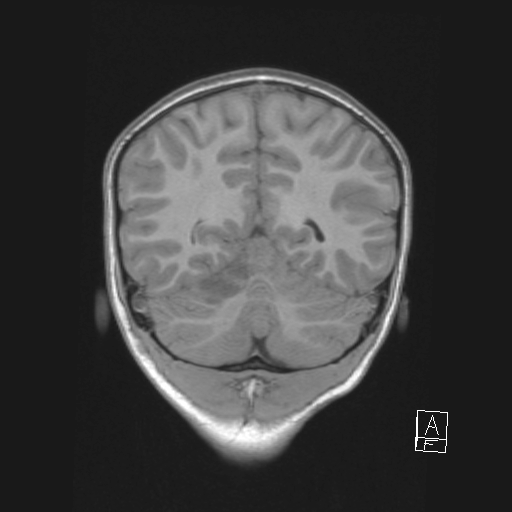 Cerebellar stroke (Radiopaedia 32202-33150 Coronal T1 45).png