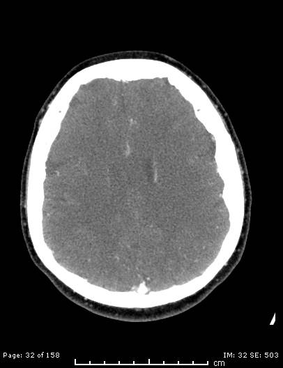 Cerebellar strokes due to intracranial giant cell arteritis (Radiopaedia 68799-78510 CT angiogram 32).jpg