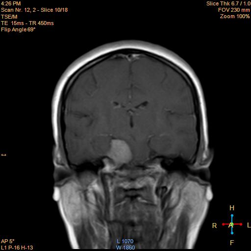 File:Cerebellopontine angle meningioma (Radiopaedia 22488-22525 Coronal T1 C+ 10).jpg