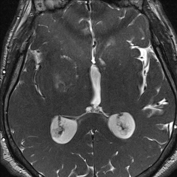 Cerebellopontine angle meningioma (Radiopaedia 24459-24764 I 54).jpg