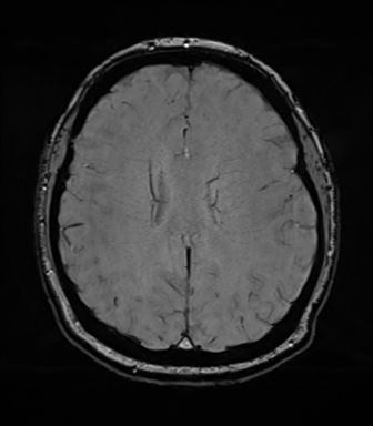 Cerebellopontine angle meningioma (Radiopaedia 48434-53348 Axial SWI 60).png