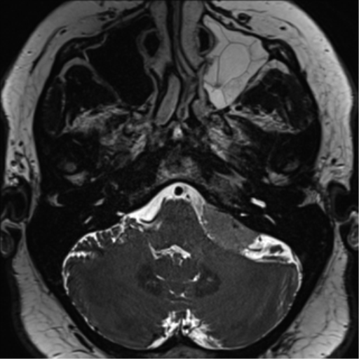 Cerebellopontine angle meningioma (Radiopaedia 48434-53348 Axial T2 Space 44).png