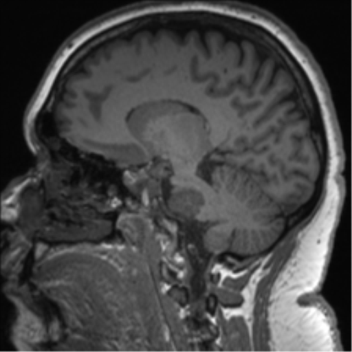 Cerebellopontine angle meningioma (Radiopaedia 48434-53348 Sagittal T1 41).png