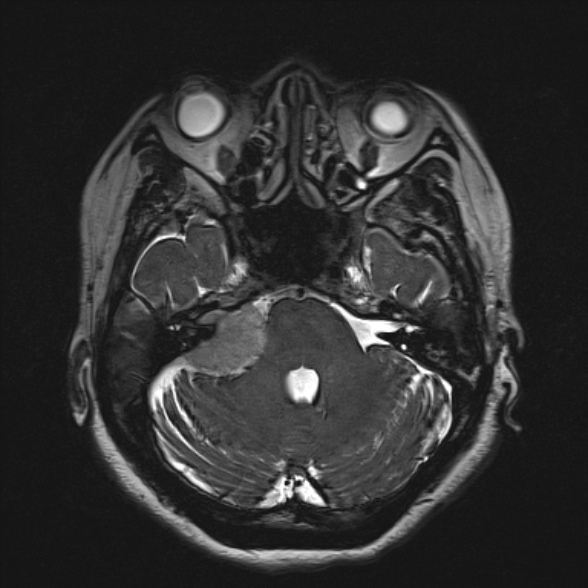 Cerebellopontine angle meningioma (Radiopaedia 53561-59591 Axial 3D volume T2 64).jpg
