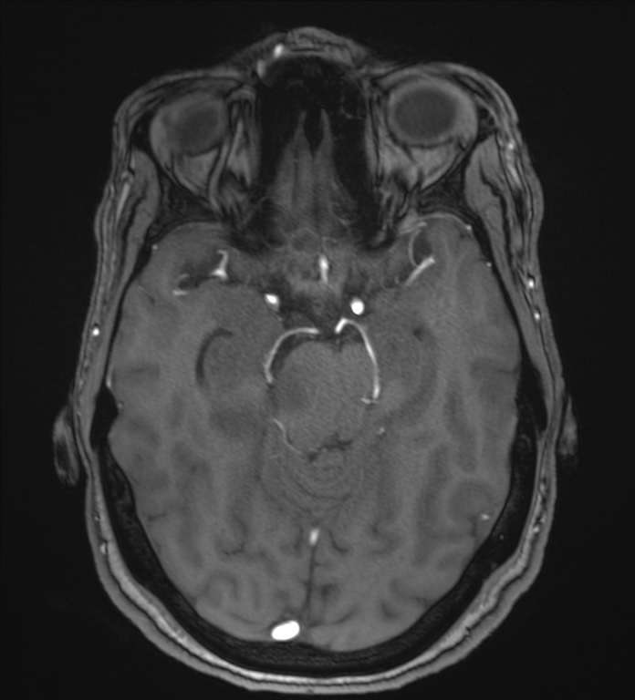Cerebellopontine angle meningioma (Radiopaedia 72983-83680 Axial MRA 47).jpg