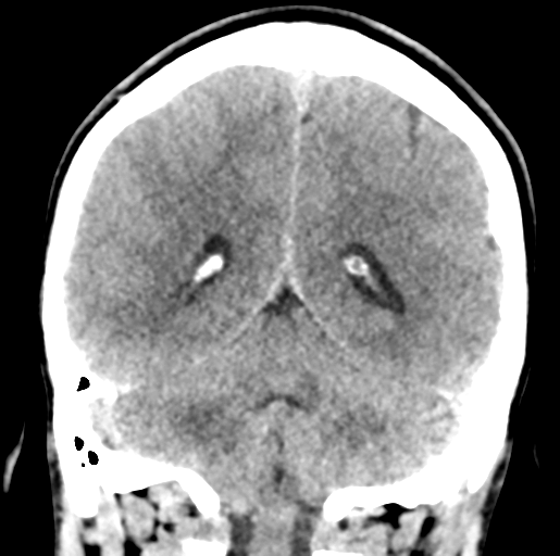 File:Cerebral abscess (Radiopaedia 60342-68008 Coronal non-contrast 44).png
