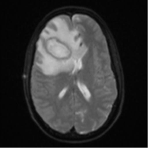 Cerebral abscess (Radiopaedia 60342-68009 Axial DWI 21).png