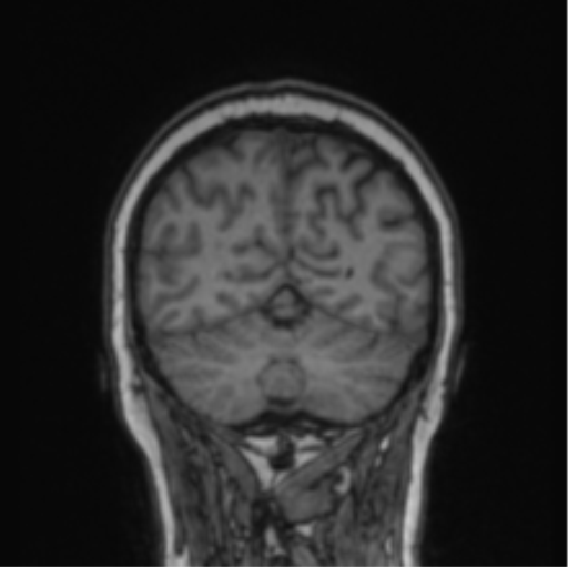 File:Cerebral abscess from pulmonary arteriovenous malformation (Radiopaedia 86275-102291 Coronal T1 24).png
