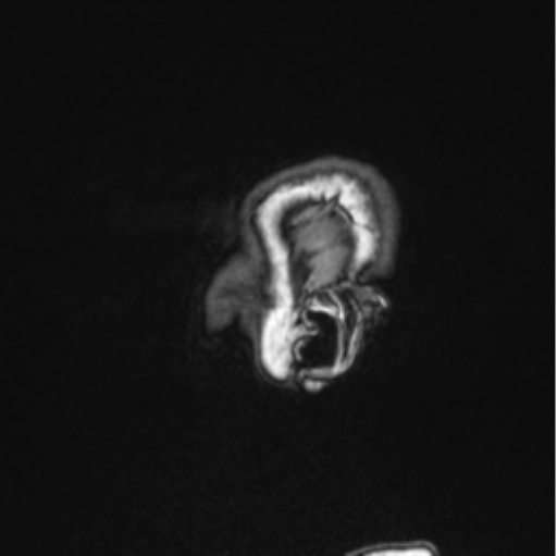 File:Cerebral abscess from pulmonary arteriovenous malformation (Radiopaedia 86275-102291 Sagittal T1 18).png