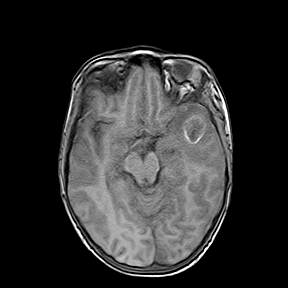File:Cerebral abscess post cardiac surgery (Radiopaedia 27244-27420 Axial T1 10).jpg