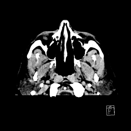 File:Cerebral abscess with ventriculitis (Radiopaedia 78965-91877 A 2).jpg