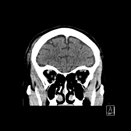 File:Cerebral abscess with ventriculitis (Radiopaedia 78965-91877 B 13).jpg