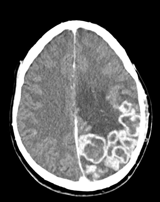 Cerebral abscesses (Radiopaedia 70458-80568 Axial Contrast 41).jpg