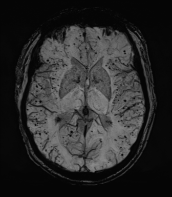 File:Cerebral amyloid angiopathy (Radiopaedia 46082-50433 Axial SWI MIP 39).png
