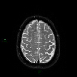 Cerebral amyloid angiopathy (Radiopaedia 77506-89664 Axial DWI 51).jpg