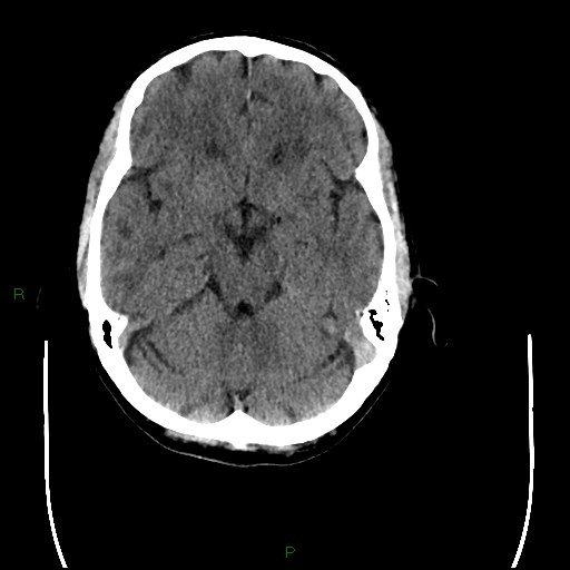 File:Cerebral amyloid angiopathy (Radiopaedia 77506-89665 Axial non-contrast 38).jpg
