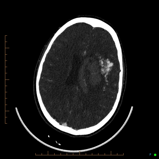 Cerebral arteriovenous malformation (AVM) (Radiopaedia 78162-90706 Axial CTA 177).jpg