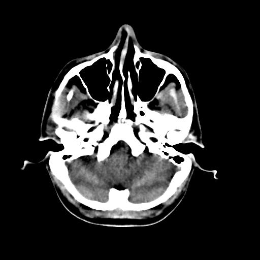Cerebral arteriovenous malformation (Radiopaedia 28518-28759 Axial non-contrast 11).jpg