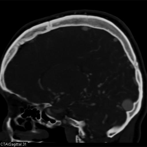 Cerebral arteriovenous malformation (Radiopaedia 28518-28759 D 28).jpg