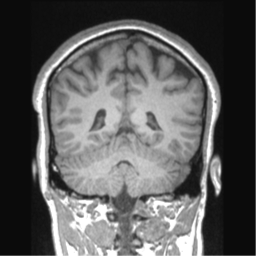 Cerebral arteriovenous malformation (Radiopaedia 39259-41506 Coronal T1 32).png