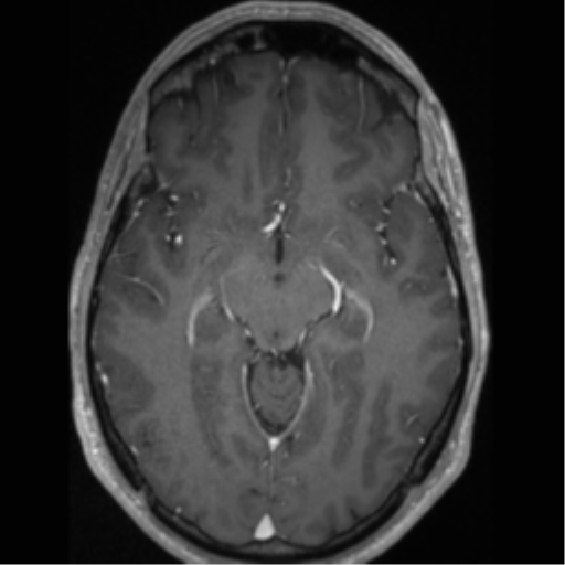 Cerebral arteriovenous malformation (Radiopaedia 55798-62372 Axial T1 C+ 32).png