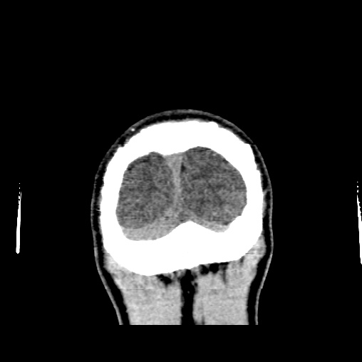 Cerebral arteriovenous malformation (Radiopaedia 61964-70028 Coronal non-contrast 57).jpg