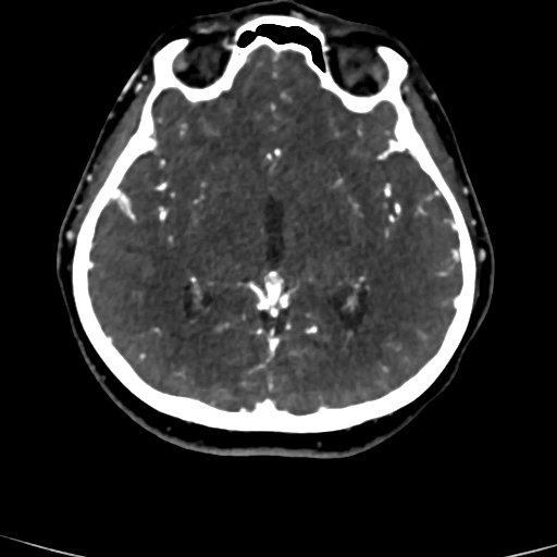 Cerebral arteriovenous malformation (Radiopaedia 73830-84645 Axial C+ delayed 49).jpg