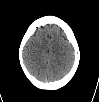File:Cerebral arteriovenous malformation (Radiopaedia 74411-85744 Axial non-contrast 28).jpg