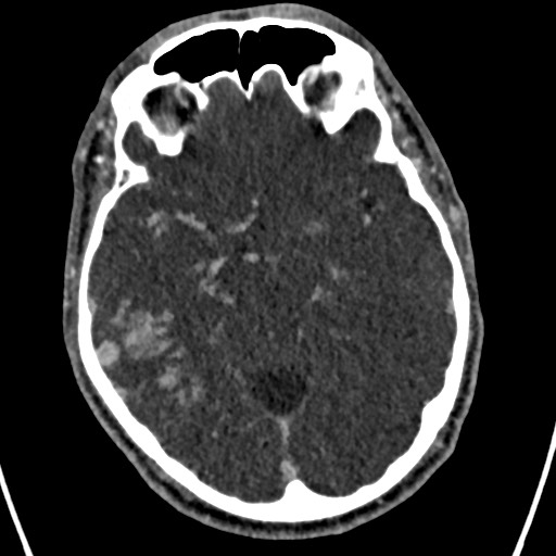 Cerebral arteriovenous malformation (Radiopaedia 78188-90746 Axial C+ delayed 72).jpg