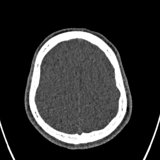 Cerebral arteriovenous malformation (Radiopaedia 78188-90746 Axial non-contrast 145).jpg