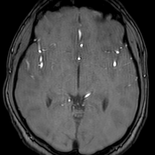 Cerebral arteriovenous malformation at posterior body of corpus callosum (Radiopaedia 74111-84925 Axial MRA 98).jpg