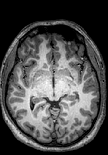 File:Cerebral arteriovenous malformation at posterior body of corpus callosum (Radiopaedia 74111-84925 Axial T1 167).jpg