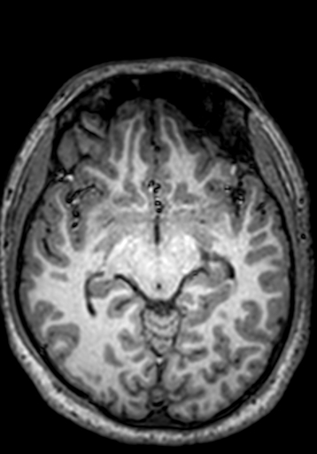 File:Cerebral arteriovenous malformation at posterior body of corpus callosum (Radiopaedia 74111-84925 Axial T1 174).jpg