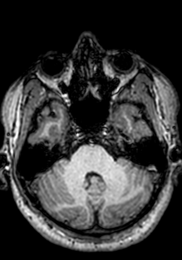 Cerebral arteriovenous malformation at posterior body of corpus callosum (Radiopaedia 74111-84925 Axial T1 237).jpg