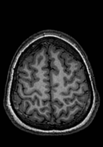 Cerebral arteriovenous malformation at posterior body of corpus callosum (Radiopaedia 74111-84925 Axial T1 41).jpg