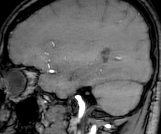 Cerebral arteriovenous malformation at posterior body of corpus callosum (Radiopaedia 74111-84925 J 103).jpg