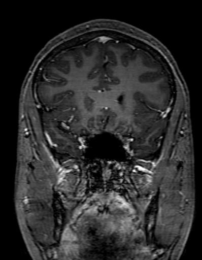 Cerebral arteriovenous malformation at posterior body of corpus callosum (Radiopaedia 74111-84925 K 111).jpg