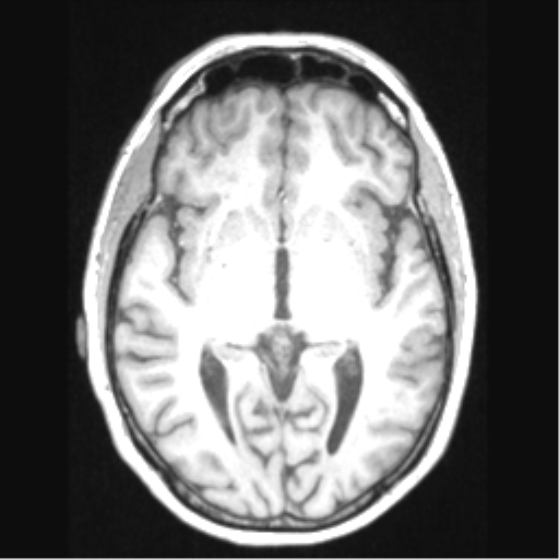 Cerebral arteriovenous malformation with hemorrhage (Radiopaedia 34422-35737 Axial T1 37).png