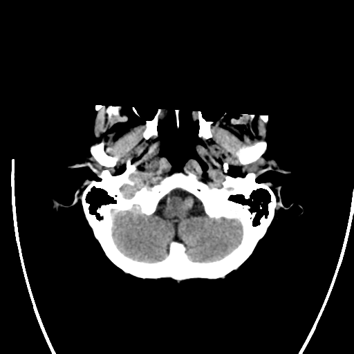 File:Cerebral arteriovenous malformation with lobar hemorrhage (Radiopaedia 44725-48512 Axial non-contrast 9).png