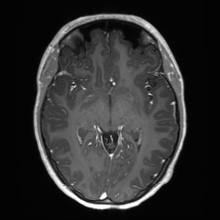 File:Cerebral cavernous venous malformation (Radiopaedia 70008-80021 Axial T1 C+ 32).jpg