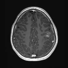 Cerebral cavernous venous malformation (Radiopaedia 70008-80021 Axial T1 C+ 70).jpg
