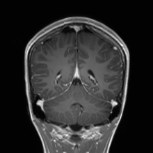 Cerebral cavernous venous malformation (Radiopaedia 70008-80021 Coronal T1 C+ 21).jpg